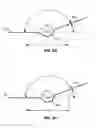 Fig. 08 - STENT DELIVERY SYSTEMS WITH SHAPED EXPANSION BALLOONS