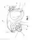 Fig. 04 - Stomal diverter device