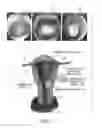 Fig. 02 - Fallopian biocompatible plug with differently expandable portions