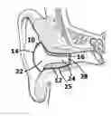 Fig. 01 - Vented Sound Attenuation Earplug System