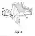 Fig. 02 - Vented Sound Attenuation Earplug System