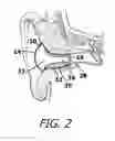 Fig. 03 - Vented Sound Attenuation Earplug System