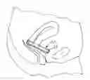 Fig. 01 - Cervical pad
