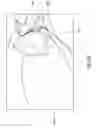 Fig. 28 - NEGATIVE PRESSURE WOUND CLOSURE DEVICE