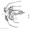 Fig. 33 - NEGATIVE PRESSURE WOUND CLOSURE DEVICE