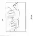 Fig. 37 - NEGATIVE PRESSURE WOUND CLOSURE DEVICE