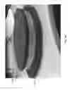 Fig. 56 - NEGATIVE PRESSURE WOUND CLOSURE DEVICE