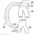 Fig. 01 - Apparatus and Methods for Preventing or Treating Failure of Hemodialysis Vascular Access and Other Vascular Grafts