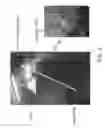 Fig. 03 - LESION IDENTIFICATION MARKER UTILIZING BONE CEMENT FOR USE IN RADIATION THERAPY, AND LESION IDENTIFICATION MARKER KIT FOR USE IN RADIATION THERAPY