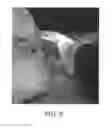 Fig. 09 - LESION IDENTIFICATION MARKER UTILIZING BONE CEMENT FOR USE IN RADIATION THERAPY, AND LESION IDENTIFICATION MARKER KIT FOR USE IN RADIATION THERAPY