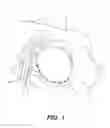 Fig. 02 - BREAST TREATMENT DEVICE
