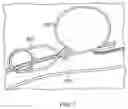 Fig. 08 - Devices and methods for aneurysm treatment