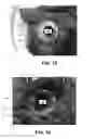 Fig. 10 - HEART CANNULA