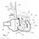 Fig. 02 - Circulatory assistance device