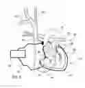 Fig. 03 - Circulatory assistance device