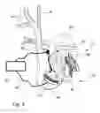 Fig. 04 - Circulatory assistance device
