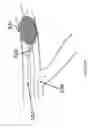 Fig. 14 - Systems and methods for providing zones of selective thermal therapy