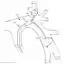 Fig. 01 - Multi-Catheter Infusion System and Method of Use