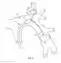 Fig. 06 - Multi-Catheter Infusion System and Method of Use