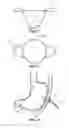 Fig. 03 - Gastrostomy tube reinsertion device