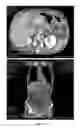 Fig. 28 - Method of relieving or alleviating pain suffered by abdominal cancer patients