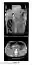 Fig. 32 - Method of relieving or alleviating pain suffered by abdominal cancer patients