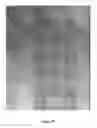 Fig. 33 - Method of relieving or alleviating pain suffered by abdominal cancer patients