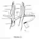 Fig. 16 - Transvascular nerve stimulation apparatus and methods