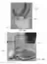 Fig. 79 - INTRA-ORAL LIGHT-THERAPY APPARATUSES AND METHODS FOR THEIR USE