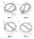 Fig. 03 - DEPOSITION OF BRAZE PREFORM