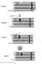 Fig. 05 - Vertical embedded component in a printed circuit board blind hole