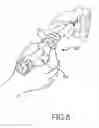 Fig. 06 - Facet joint implants and delivery tools