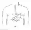 Fig. 02 - Resection line guide for a medical procedure and method of using same