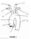 Fig. 02 - THROMBUS RETRIEVAL STENTS AND METHODS OF USING FOR TREATMENT OF ISCHEMIC STROKE