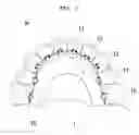 Fig. 02 - Dental brace and method for attaching dental brace