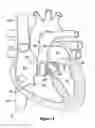 Fig. 03 - Native valve repair devices and procedures