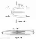Fig. 26 - Native valve repair devices and procedures