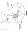 Fig. 57 - Native valve repair devices and procedures