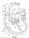 Fig. 02 - Native valve repair devices and procedures