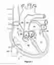 Fig. 02 - Native valve repair devices and procedures