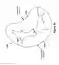 Fig. 46 - Native valve repair devices and procedures
