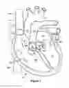 Fig. 02 - Native valve repair devices and procedures