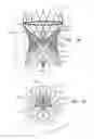 Fig. 02 - Prosthetic aortic valve pacing system