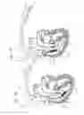 Fig. 09 - Percutaneous implant retrieval connector and method