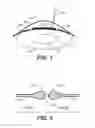 Fig. 02 - Laser assisted cataract surgery