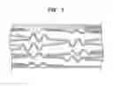 Fig. 02 - Stents Having Biodegradable Layers