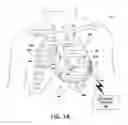 Fig. 02 - Adaptive cardiac resynchronization therapy