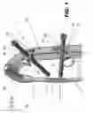 Fig. 02 - Instrument for aligning fixing screws to be inserted in transverse holes of nails for long bones, in particular medullary nails