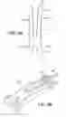 Fig. 03 - Scleral prosthesis for treating presbyopia and other eye disorders and related devices and methods