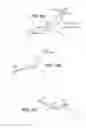 Fig. 12 - Scleral prosthesis for treating presbyopia and other eye disorders and related devices and methods